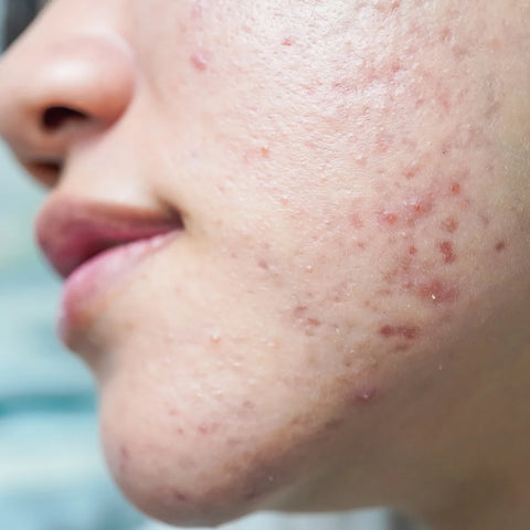 Niacinamide-Benefits-for-Acne-Prone-Skin-A-Complete-Guide Pals Skin Lab