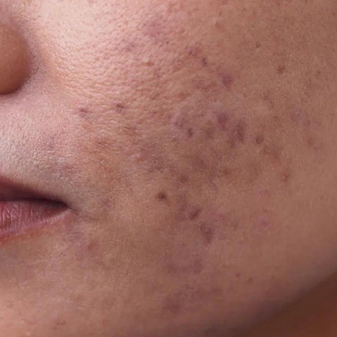 Image showing a face with Hyperpigmentation & Dark Spots before applying Pal's Vitamin C serum
