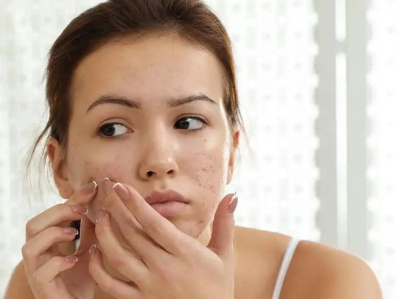 Combatting-Breakouts-The-Definitive-Skincare-for-Acne-Prone-Skin Pals Skin Lab