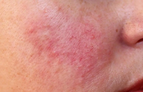 Say-Goodbye-to-Redness-Your-Complete-Guide-to-Healthy-Glowing-Skin Pals Skin Lab