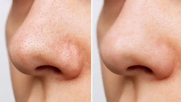 The-Best-Skincare-for-Pores-Go-Gentle-with-BHA-Niacinamide Pals Skin Lab