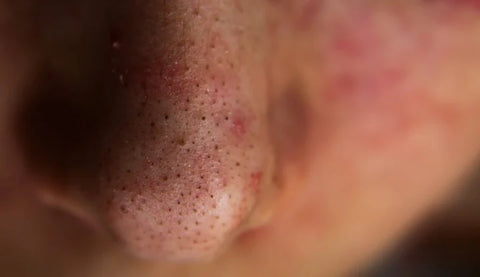 Blackhead removal 