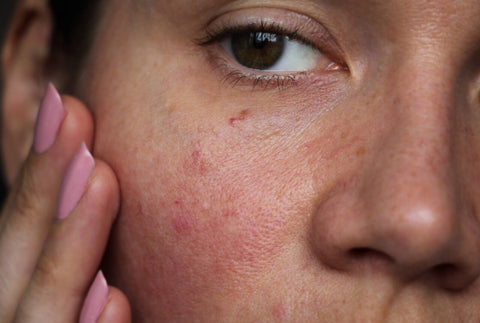 REDNESS - Pals Skin Lab