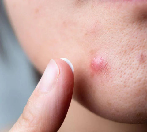 close up image of an acne pimple before using pal's salicylic acid serum