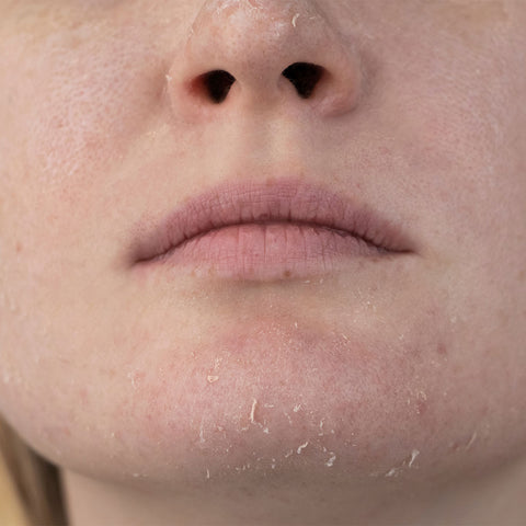 image showing a close up a women's face with dry skin 