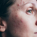 Acne Clear Kit Pals Skin Lab