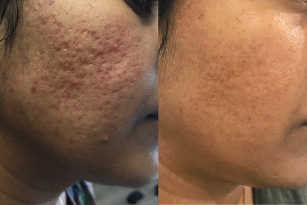 I’ve tried so many products after battling adult acne, im 1 month in of using this every 1-2 days and I can’t believe it, I haven’t had any large pimples since and my acne scarring is fading