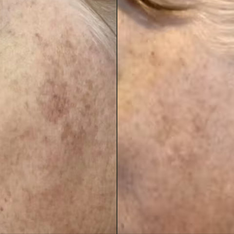 Big improvement in pigmentation!